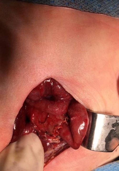 CASES OF THE WEEK – “Rare case of male baby with Down syndrome & duodenal atresia (antenatal finding) & operated at 26 hours of life” by Dr Wissam AlTamr, Specialist Paediatric Surgery 03